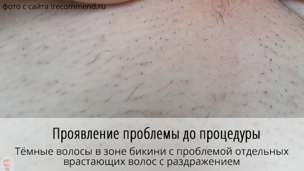 фото до лазерной эпиляции бикини