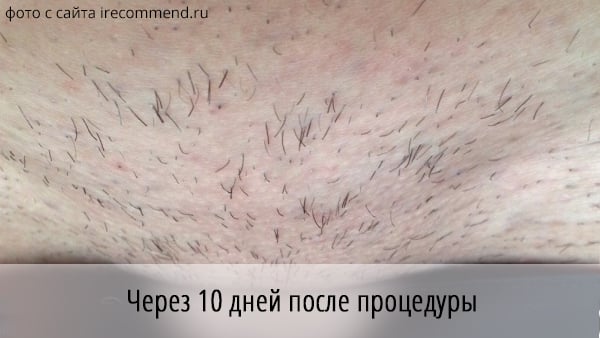 фото бикини через 10 дней после эпиляции